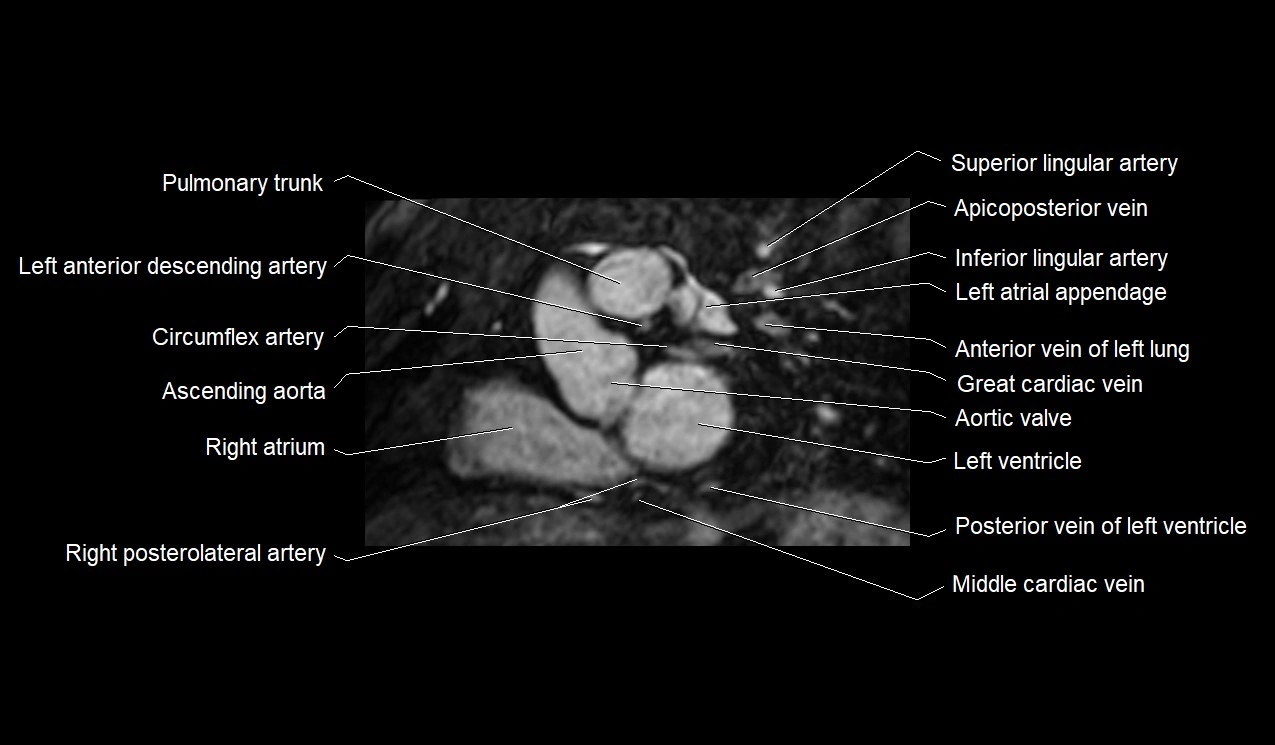 MRI heart and coronary arteries short axis anatomy image 16.webp